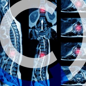 indianapolis spinal cord injuries lawyer