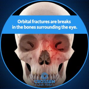 orbital fracture